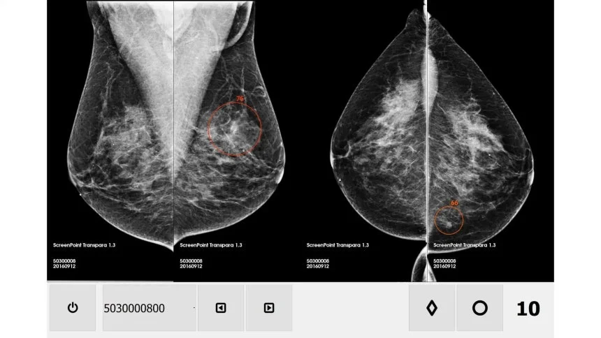 [사이언스샷] AI 진단, 악성 유방암 발병 12% 낮췄다